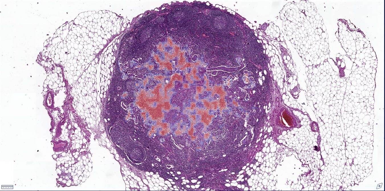 Lymph Node Metastasis